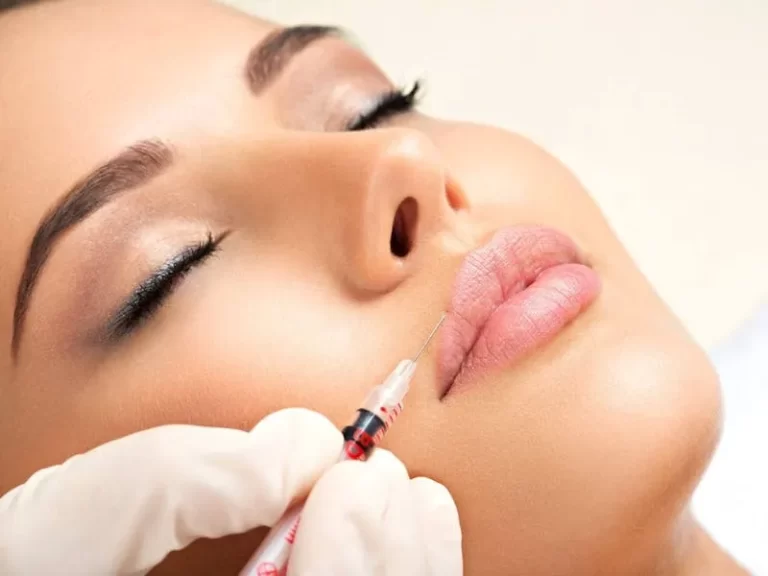 How Long Do Lip Injections Last After Fillers?